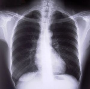 poza despre tuberculoza pulmonara